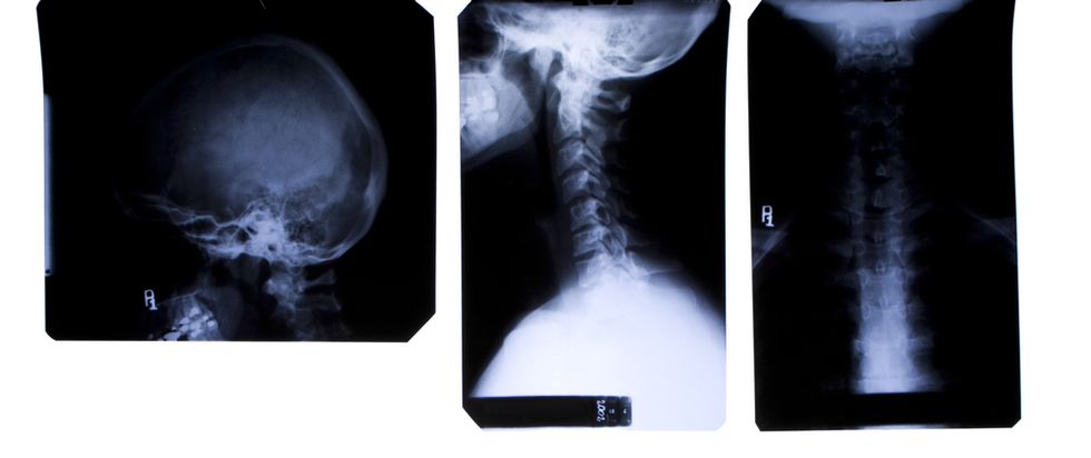 Doctors Baffled by Random Object Revealed in X-Ray to Be Lodged Inside Patient's Throat