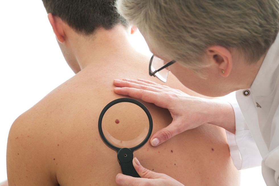 This Quick and Easy Test Can Help You Determine if You Could Have a Cancerous Mole